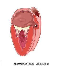 Section Through Heart Showing The Left Atrium And Left Atrial Appendage, Where Stagnant Blood Can Clot, Leading To Embolism
