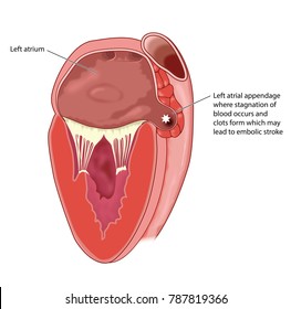 Section Through Heart Showing The Left Atrium And Left Atrial Appendage, Where Stagnant Blood Can Clot, Leading To Embolism
