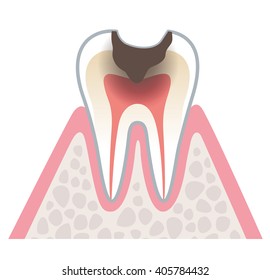 Sectional View Tooth Decay Stock Illustration 405784432 | Shutterstock