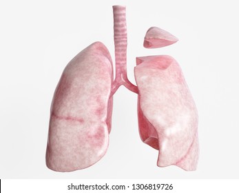 Segmental resection after severe lung disease - 2 of 4 - 3D Rendering