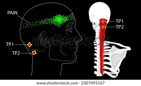 Semispinalis muscles. Trigger points and referred pain