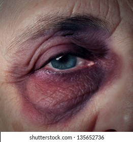 Senior Abuse Or Elder Mistreatment As An Old Person With A Black Eye Bruised And Injured From Domestic Violence From A Retirement Home Or Caretaker As Broken Trust Legal Health Care Concept.