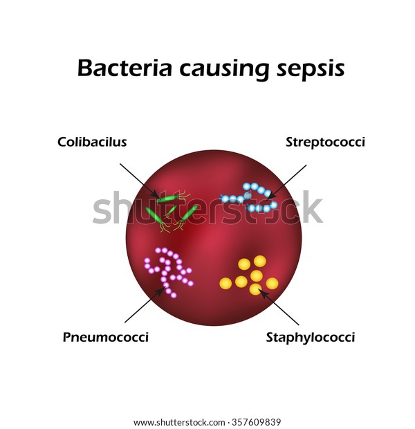 Sepsis Blood Poisoning E Coli Streptococci Stock Illustration 357609839