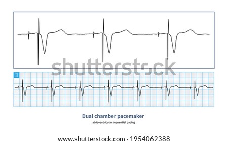 Sequential atrioventricular pacing can make pacemaker simulate normal atrioventricular contraction sequence and produce the best hemodynamic effect.