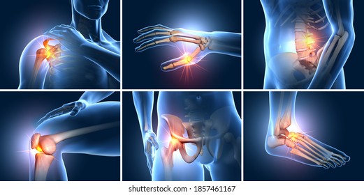 A set of six painful joints, medical 3D illustration