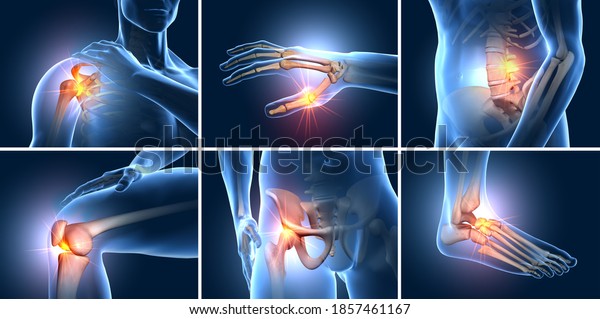 A set of six painful joints, medical 3d illustration