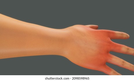 Shaking Tremor In Human Hands 3d Illustration