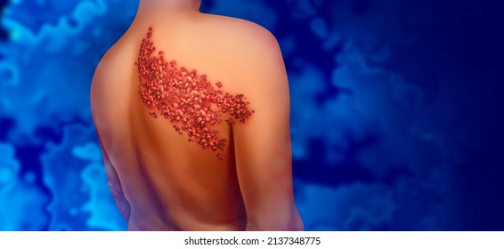 Shingles disease viral infection concept as a medical illustration with skin blisters hives and sores on a human back torso as a health symbol for a painful rash condition in a 3D illustration style.
