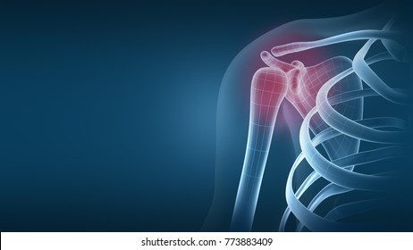 Shoulder Osteoarthritis X-ray On Hi-tech Background