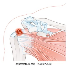 Shoulder Pain. Rotator Cuff Tear