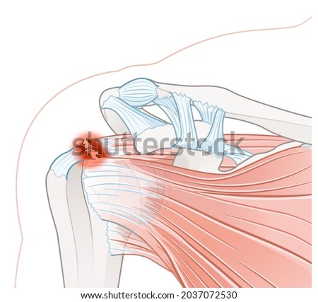 Shoulder pain. Rotator cuff tear Imagine de stoc © 