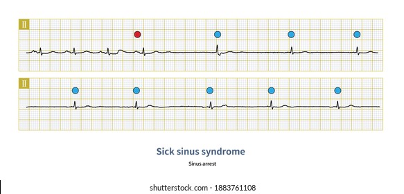 147 Sinus arrest Images, Stock Photos & Vectors | Shutterstock