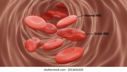 Sickle Cell Anemia In 3D Illustration