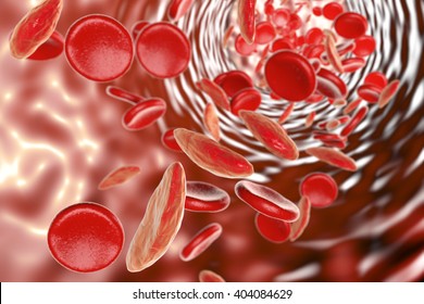 Sickle Cell Anemia, 3D Illustration Showing Blood Vessel With Normal And Deformated Red Blood Cells
