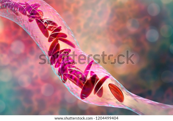 Sickle Cell Anemia 3d Illustration Clumps Stock Illustration 1204499404 Shutterstock 6008