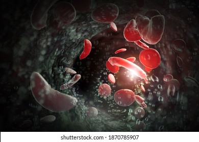 Illustration 3D des cellules sanguines de la drépanocytose (SCD)