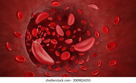 Sickle Cells In Blood Stream, Sickle Cell Anemia 3d Illustration