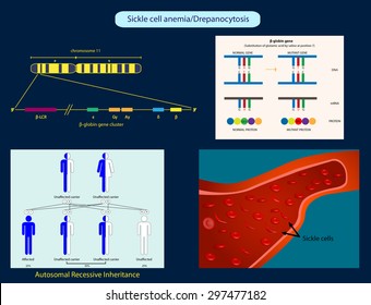 Sicklecell Anemia Stock Illustration 297477182 | Shutterstock