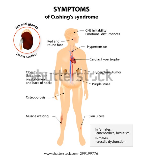 Signs Symptoms Cushings Syndrome Labeled Human Stock Illustration 299199776 