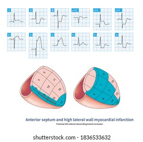 211 Left anterior descending branch Images, Stock Photos & Vectors ...