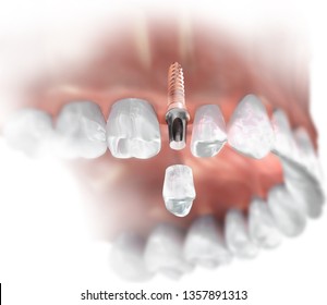 Single Tooth Replacement. 3D Illustration