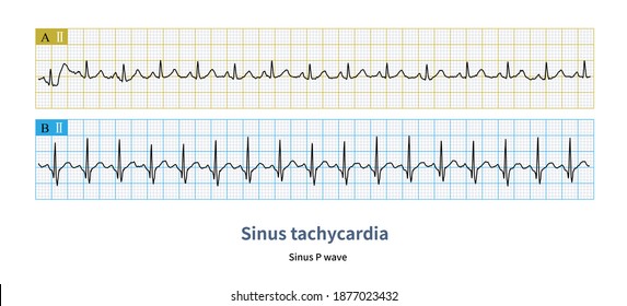 The sinus heart rate of adults exceeds  100 bpm, which is called sinus tachycardia.Under physiological conditions, it is found in sympathetic nerve excitement and movement.