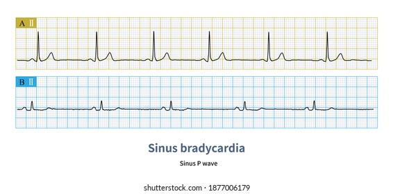 The sinus heart rate of adults is less than 60 bpm, which is called sinus bradycardia. Under physiological conditions, sinus bradycardia is seen in athletes and high vagus nerve tone.
