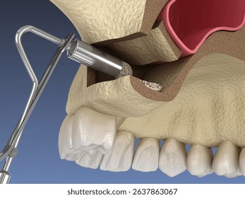 Sinus Lift Surgery - Adding artificial new bone. 3D illustration