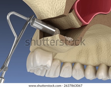 Sinus Lift Surgery - Adding artificial new bone. 3D illustration