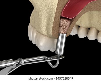 Sinus Lift Surgery - Adding New Bone. 3D Illustration