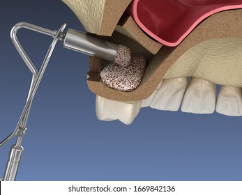 Sinus Lift Surgery - Adding New Bone. 3D Illustration