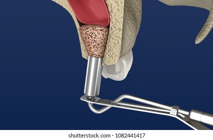 Sinus Lift Surgery - Sinus Augmentation. 3D Illustration