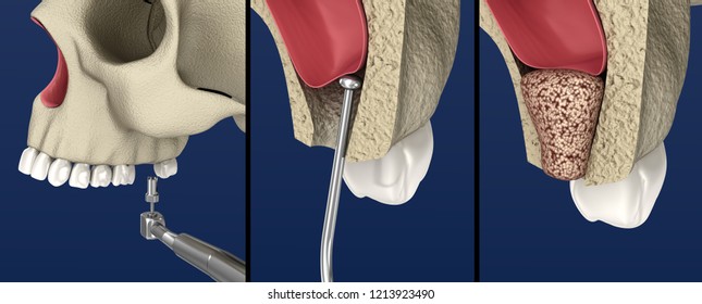 Sinus Lift Surgery - Sinus Augmentation. 3D Illustration