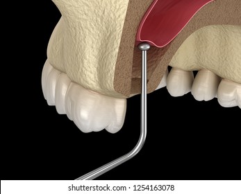 Sinus Lift Surgery - Sinus Augmentation. 3D Illustration