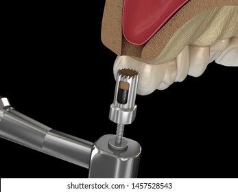 Sinus Lift Surgery Creating Access Sinus Stock Illustration 1309917607