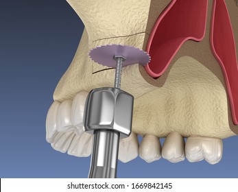 138 Sinus lift Images, Stock Photos & Vectors | Shutterstock