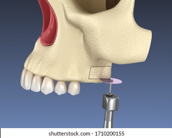 138 Sinus lift Images, Stock Photos & Vectors | Shutterstock