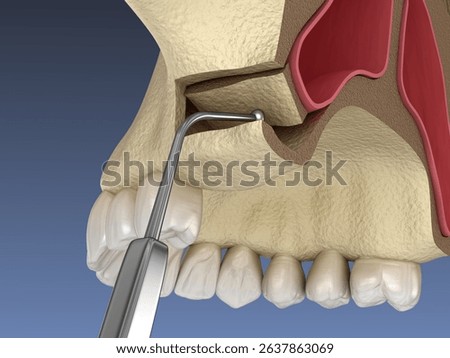 Sinus Lift Surgery - Creating side access to the Sinus. 3D illustration