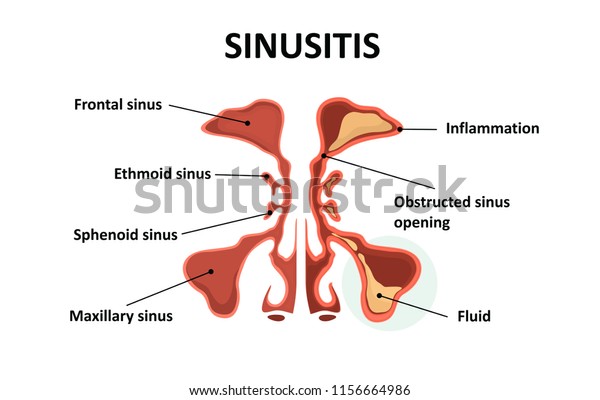 Sinusitis Healthy Inflammation Nasal Sinus Stock Illustration ...