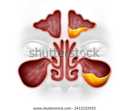 Sinusitis and healthy Sinus  as an Infection illness with nasal congestion as a cavity blockage disease with a congested nose full of mucus or pus in a 3D illustration style. Stock photo © 