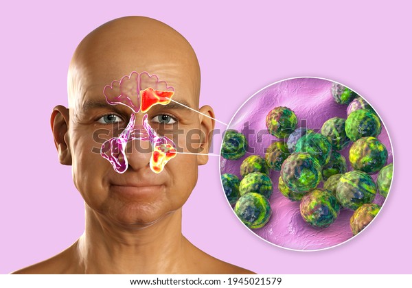 Sinusitis Inflammation Paranasal Cavities 3d Illustration Stock ...