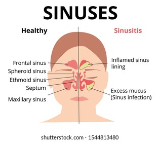 Sinusitis medical treatment. Nasal sinus. Healthy and inflammation sinus. Nasal diseases. Sinusitis, sinus infection diagnosis  medical infographic design. Otolaryngology concept. Isolated on white
