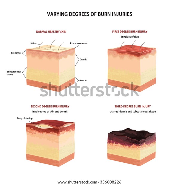 Skin Burn Classification First Second Third Stock Illustration 356008226