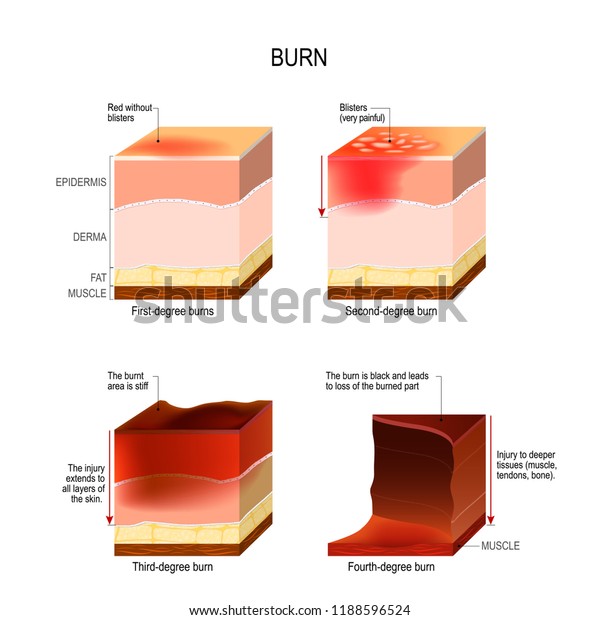 Skin Burn Four Degrees Burns Type Stock Illustration 1188596524 ...