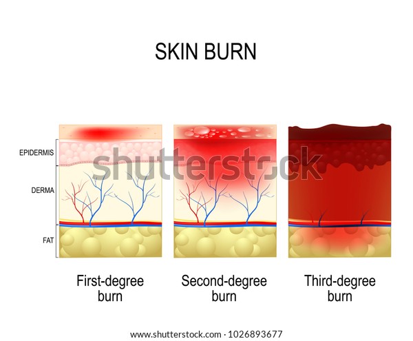 average healing time for 3rd degree burn