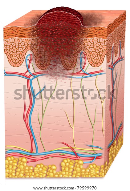 Skin Cancer Stock Illustration 79599970