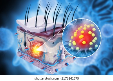 Skin cancer, medical diagram, Spreading of Cancer Cell in Human Skin layer, 3d illustration - Powered by Shutterstock