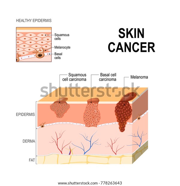 皮膚がん 扁平上皮がん 基底細胞がん 黒色腫 色素細胞に生じる メラニン形成細胞 ヒトの皮膚と健康な表皮の層 医療図 のイラスト素材