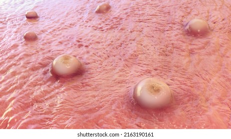 Skin lesions in monkeypox, smallpox, Molluscum contagiosum, and other Poxviridae virus infections, 3D illustration