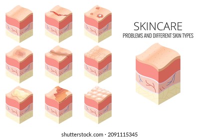 Skincare medical concept. Set of problems of different skin types in cross-section of human skin horizontal layers structure